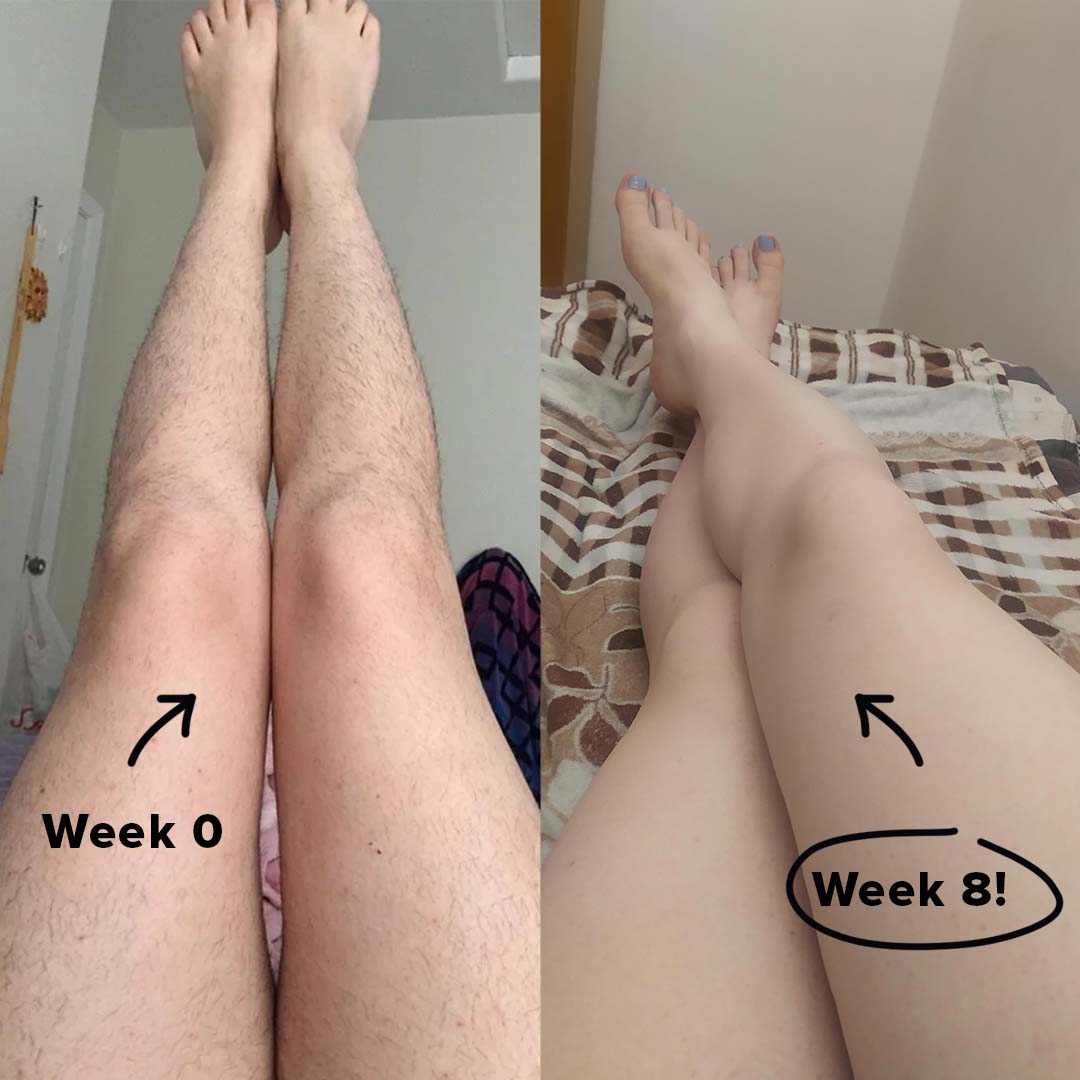 Before and after using 5MINSKIN At-Home Laser Hair Removal Handset showing hair reduction results from week 0 to week 8-Vividbella